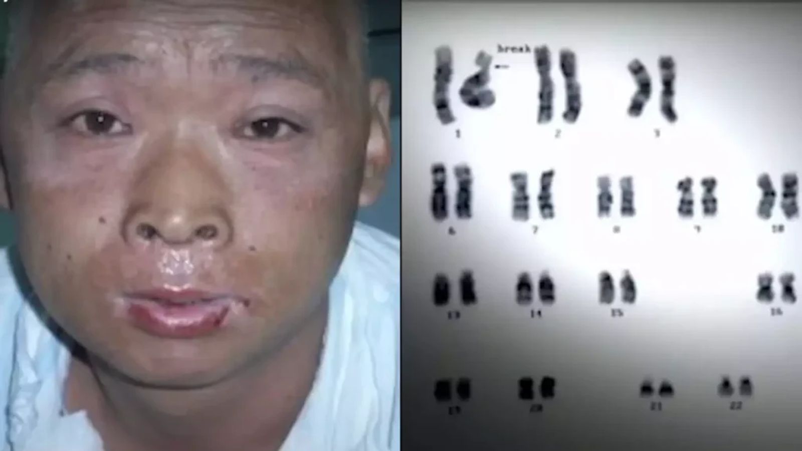 Hisashi Ouchi during treatment in October 1999. Despite stem cell transplants and transfusions, the radiation damage to his DNA and skin continued to worsen.
